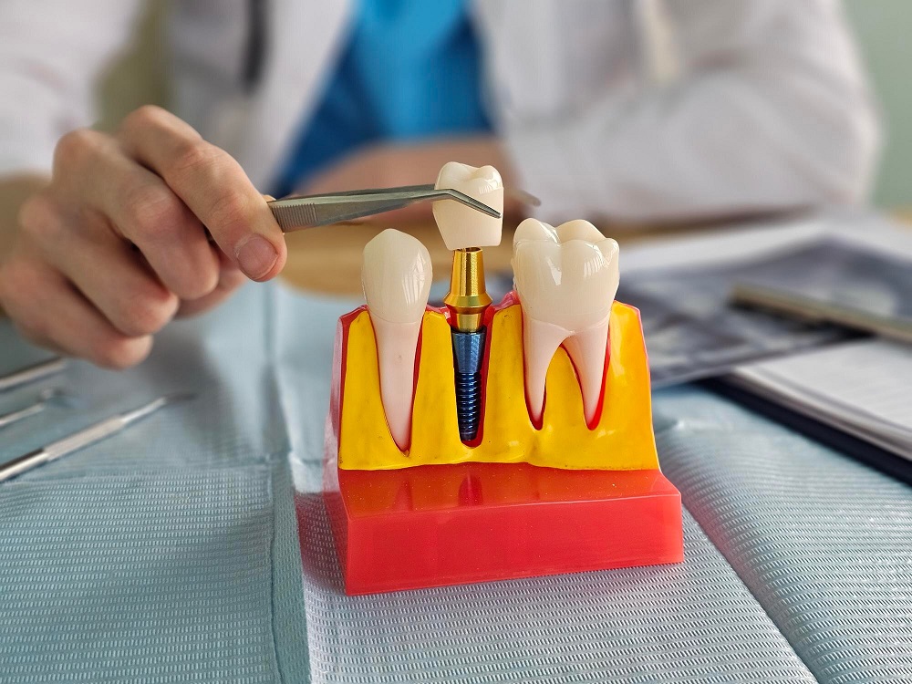 fogimplantátum fogászat