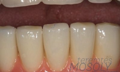 implantátumos eljárás